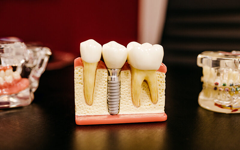 التقنيات الحديثة في زراعة الأسنان كل ما تحتاج معرفته عنها