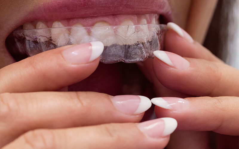 تقويم الأسنان القابلة للإزالة: ما تحتاج معرفته ومميزاته