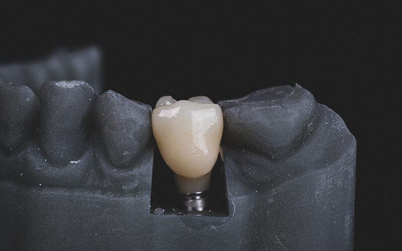 هل يمكنك زراعة الأسنان بدون جراحة وكيفية عملها